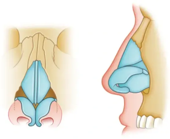 Nasal-Fracture-surgery-drhc-dubai